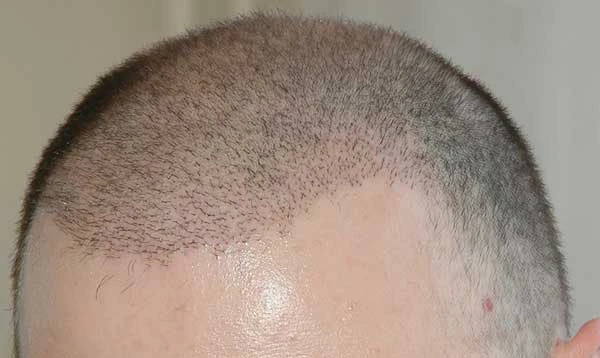کاشت (پیوند) موی طبیعی