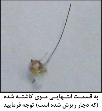 کاشت (پیوند) موی طبیعی (۲۳)