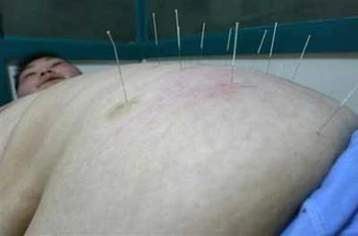 چاقی از دیدگاه طب‌سوزنی