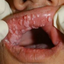 تبدیل عفونت‌HPV به سرطان 