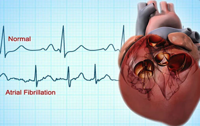 فیبریلاسیون دهلیزی و سکته مغزی